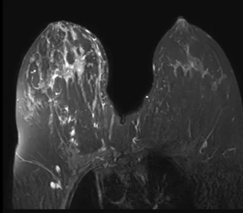 Multifocal high-grade DCIS with invasion