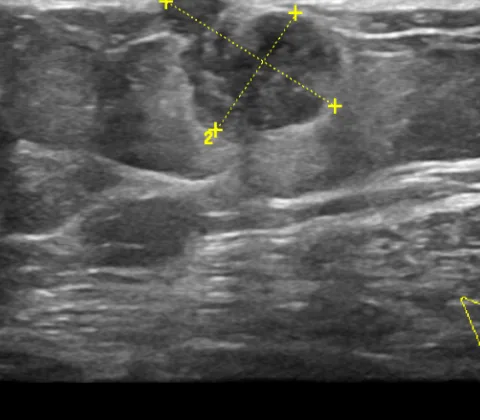 Infiltrating ductal carcinoma of the right breast