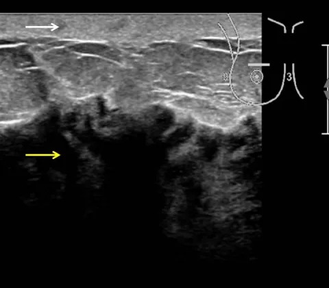 Inflammatory breast cancer