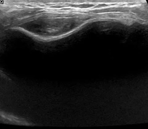 Silicone-induced breast implant capsule granuloma (SIGBIC)