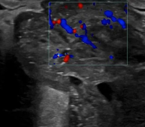 Malignant phyllodes tumour of the breast