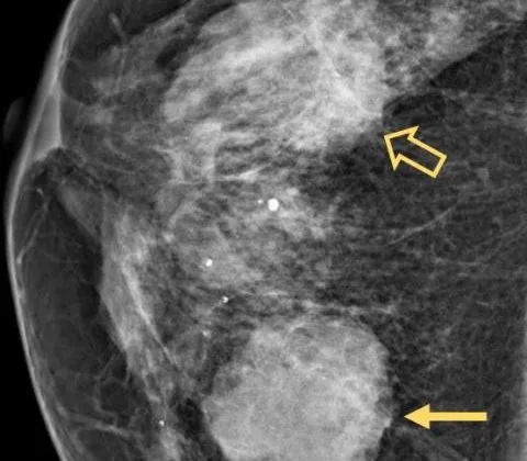 Primary breast lymphoma, diffuse large B-cell