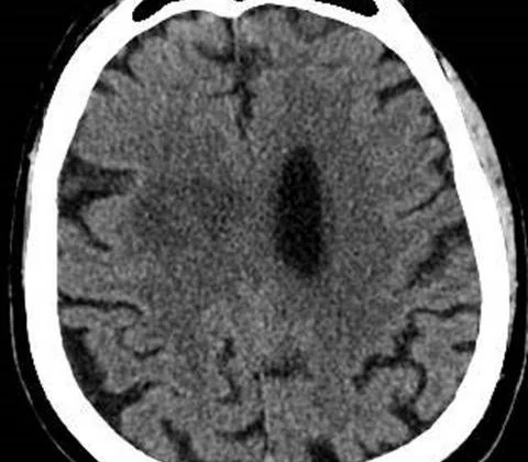 Pyogenic brain abscess with intraventricular rupture