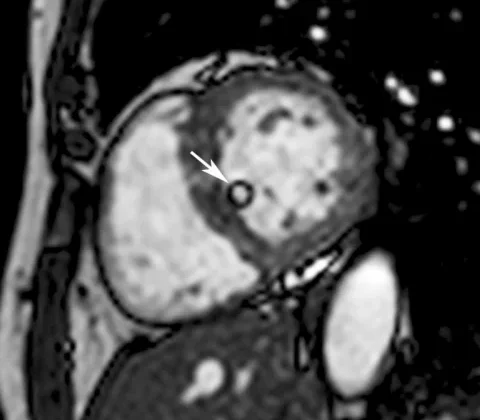 Pedunculated Intracavitary Left Ventricular Lipoma