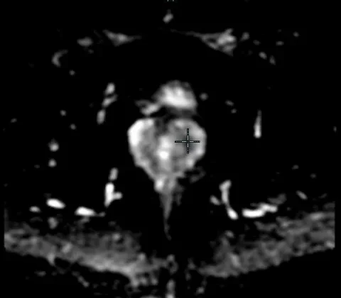 Prostate adenocarcinoma, Gleason 7 (3+4)