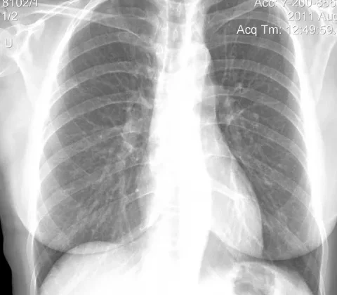 Pulmonary Nocardiosis in an Immunocompromised Patient